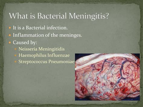 acute bacterial meningitis ppt